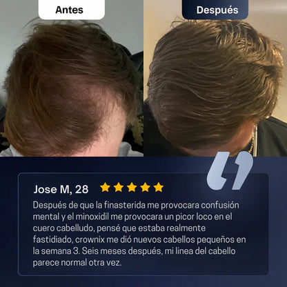 Roll-On de Crecimiento Capilar™